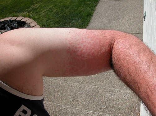 heat rashes on legs. Heat+rash