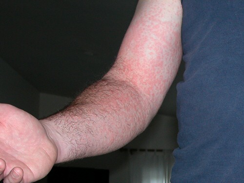pictures of heat rash on babies. heat rash on aby skin. when